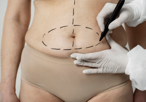 Tummy Tuck