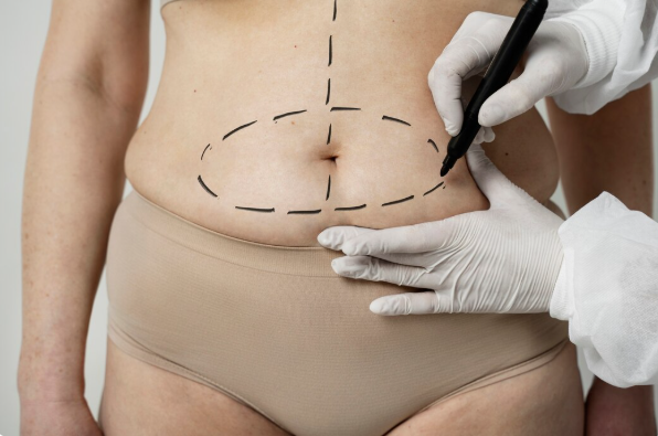 Tummy Tuck